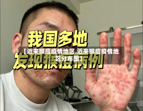 【近来猴痘疫情地区,近来猴痘疫情地区分布图】